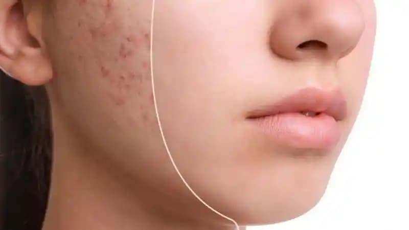 Sivilceler Ne Kadar Sürede Geçer ve Cilt Sağlığına Dair Temel Bilgiler