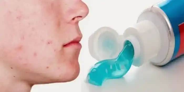 Sivilcelere Diş Macunu Sürmenin Zararları ve Doğru Cilt Bakımı Yöntemleri