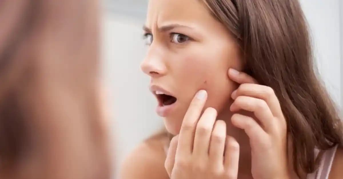 Sivilceleri Yok Etmek İçin Etkili Yöntemler ve Cilt Sağlığı Rehberi