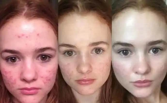 Sivilcelerin Ne Zaman Biter? Akne İyileşme Süreci ve Doğru Bakım Yöntemleri