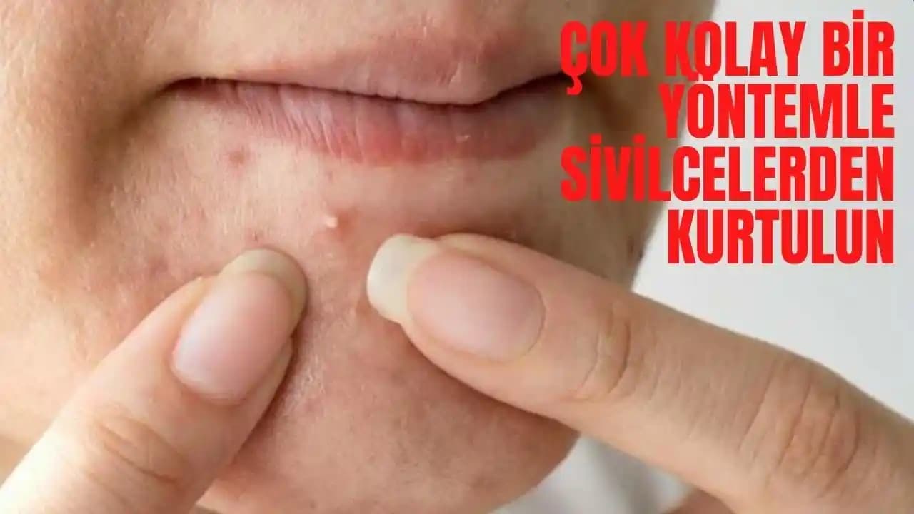 Sivilcelerle Etkili Mücadele Yöntemleri ve Cilt Sağlığını Koruma İpuçları