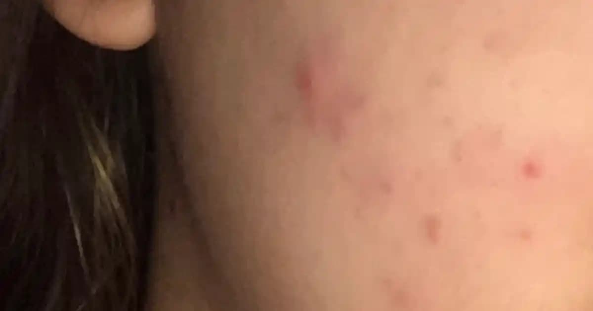 Sivilcelerle Mücadelede Doğru Bilinenler ve Etkili Çözüm Yolları Rehberi