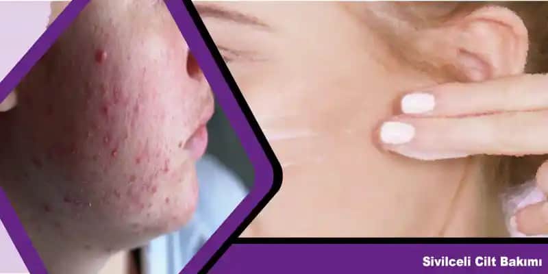 Sivilceye Karşı Etkili ve Sağlıklı Cilt Bakımı Yöntemleri Rehberi