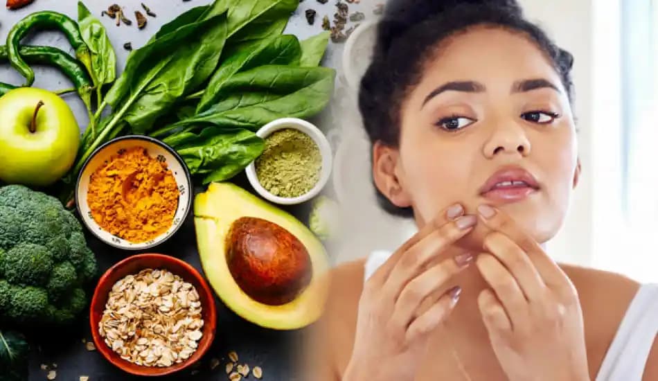 Sivilceye Neden Olan Yiyecekler ve Cilt Sağlığını Destekleyen Beslenme İpuçları