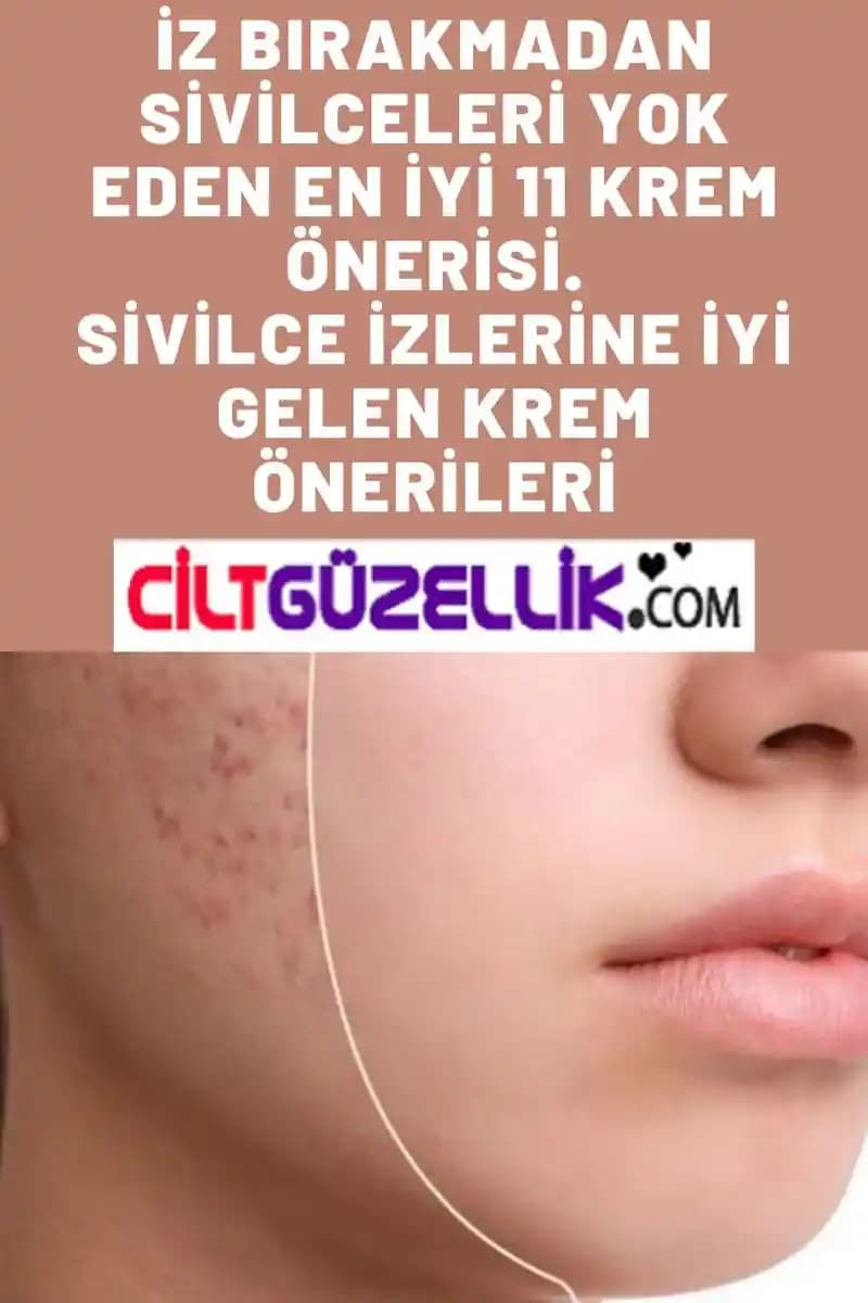 Sivilceye Yönelik Cilt Bakımı İçin Uzman Tavsiyeleri ve En Etkili Yöntemler