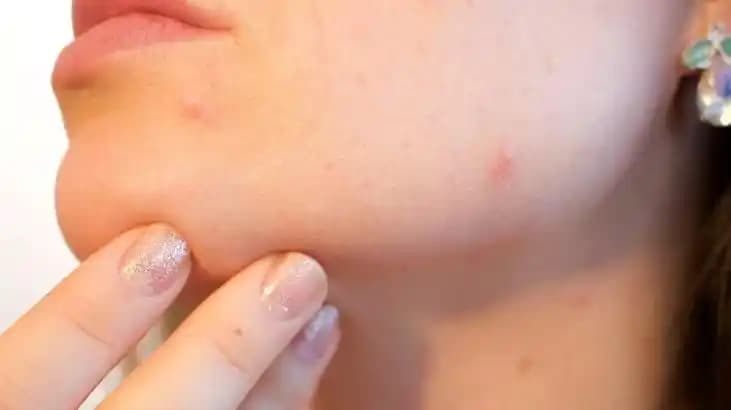 Siyah Nokta Sıkmanın Riskleri ve Doğru Cilt Bakımı Yöntemleri Hakkında Bilgiler