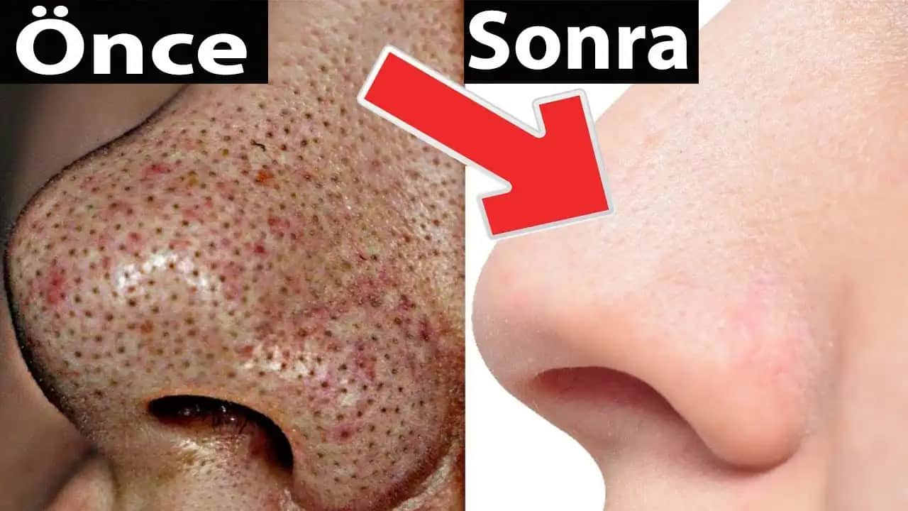 Siyah Nokta ve Sivilceyle Mücadele Yöntemleri Cilt Sağlığını Koruma Kılavuzu