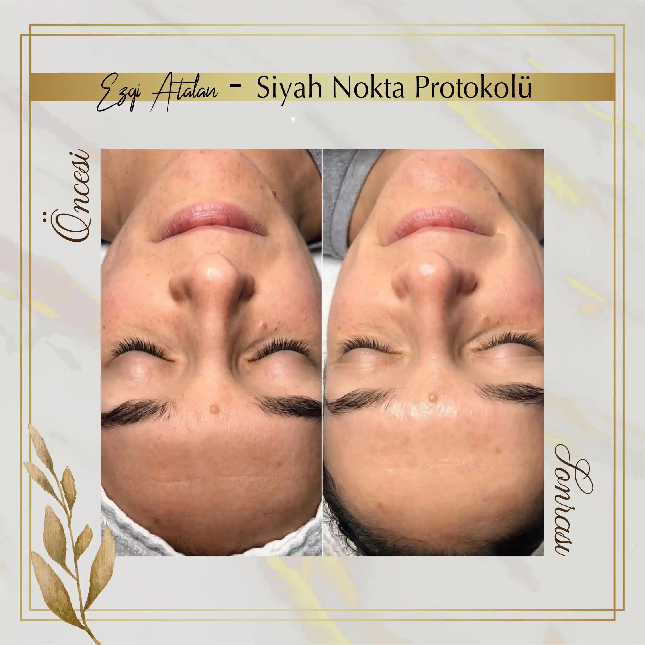 Siyah Noktalar İçin Etkili Cilt Bakımı Yöntemleri ve Profesyonel Çözümler