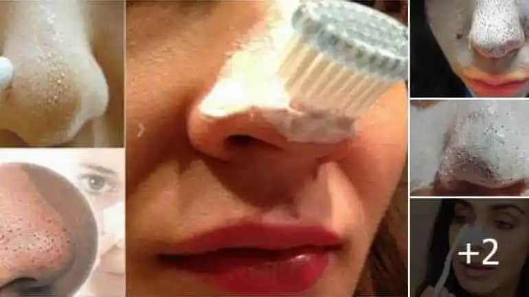 Siyah Noktalar ve Çözüm Yolları: Etkili Kozmetik ve Doğal Ürünlerle Cilt Temizliği