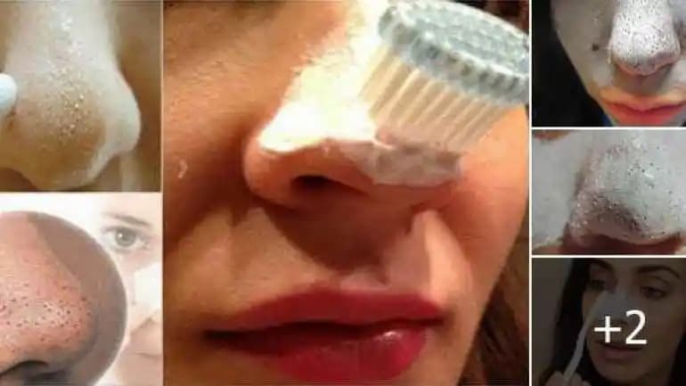 Siyah Noktalar ve Çözüm Yolları: Etkili Kozmetik ve Doğal Ürünlerle Cilt Temizliği