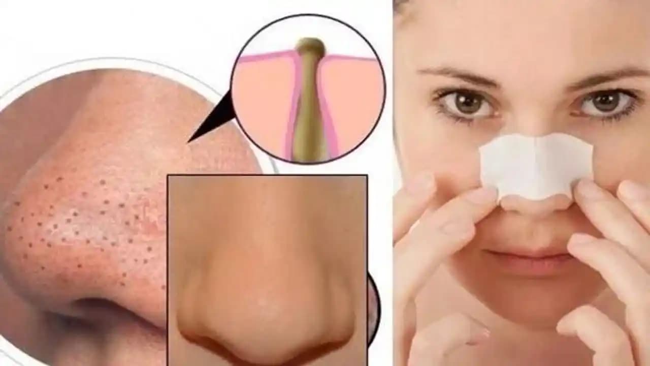 Siyah Noktalara Karşı Doğal Çözümler ve Cilt Bakımında Etkili Yöntemler