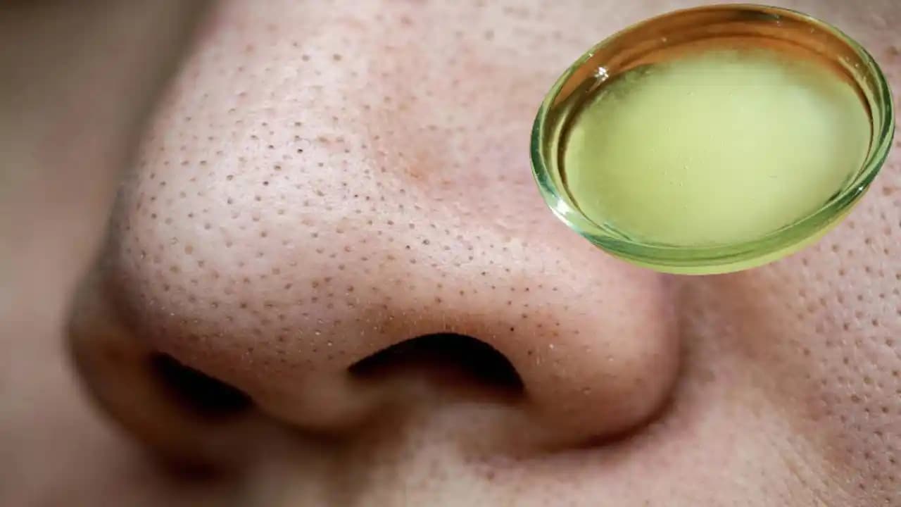 Siyah Noktalara Karşı Etkili Çözüm Yolları ve Cilt Sağlığı İpuçları