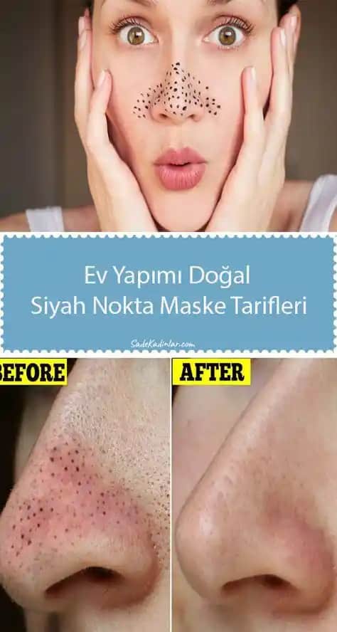 Siyah Noktalardan Kurtulmanın Etkili Yöntemleri ve Cilt Bakım İpuçları