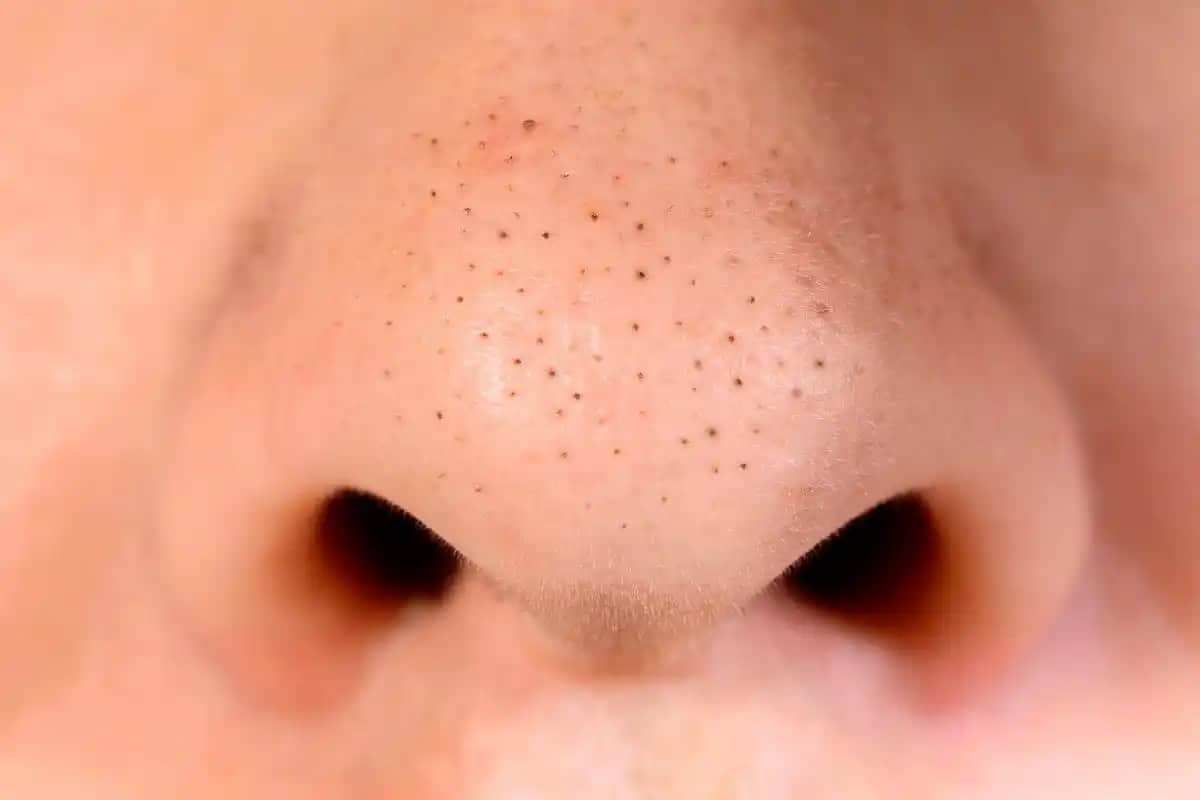 Siyah Noktalarla Başa Çıkma Yöntemleri ve Etkili Cilt Bakımı Stratejileri