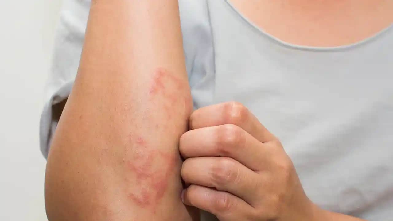 Stres ve Cilt Sağlığı: Döküntülerin Sebepleri ve Korunma Yöntemleri