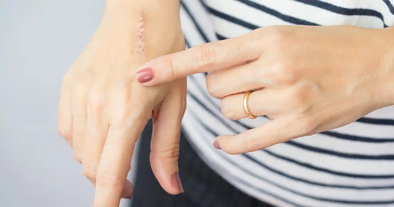 Sürtünme ile Oluşan Yaraların Tedavisi ve Kozmetik Yaklaşımlarını Anlamak