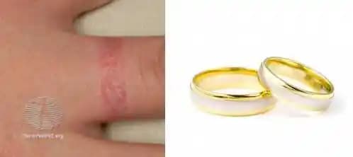 Takı Alerjisi Nedenleri, Belirtileri ve Güvenli Kullanım İpuçları