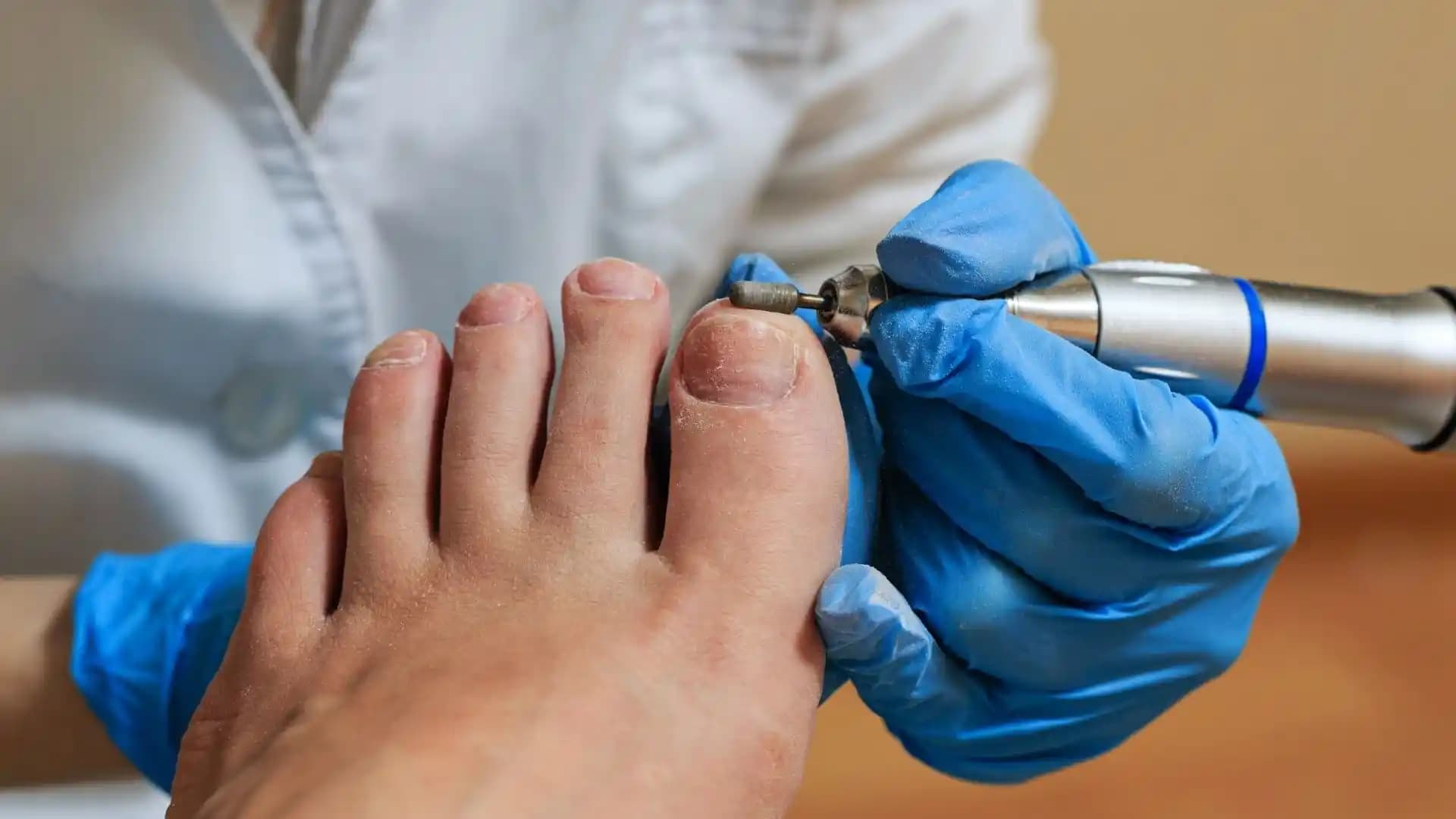 Tırnak Düşmesi Nedenleri ve Tedavi Yöntemleri: Sağlıklı ve Güzel Tırnaklar İçin Rehber