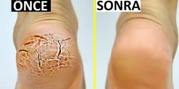 Topuk Çatlakları ve Kozmetik Bakımla Sağlıklı Ayaklar İçin Rehber