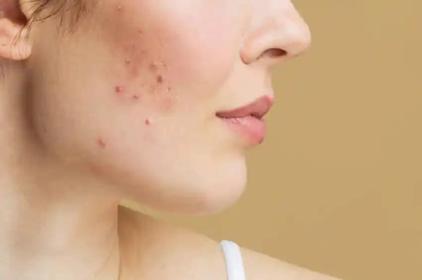 Uzun Süreli Sivilce Sorunu ve Çözüm Yolları: Nedenleri ve Etkili Tavsiyeler