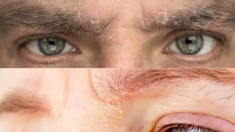 Vücut Kepeklenmesi Nedenleri ve Etkili Önleme Yöntemleri Hakkında Kapsamlı Bilgi