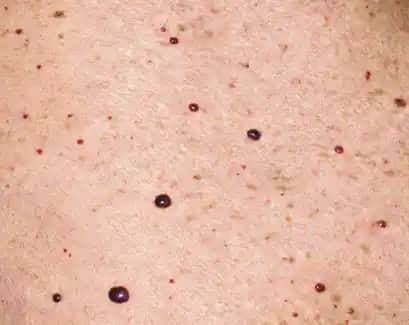 Vücutta Benek Çıkmasının Nedenleri ve Kozmetik Çözüm Yöntemleri Hakkında Detaylı Bilgi