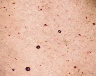 Vücutta Benek Çıkmasının Nedenleri ve Kozmetik Çözüm Yöntemleri Hakkında Detaylı Bilgi