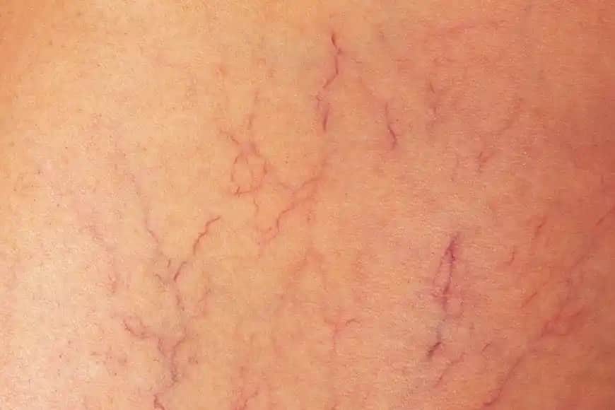 Vücutta Damar Çatlaması Nedenleri ve Kozmetik Çözüm Yöntemleri