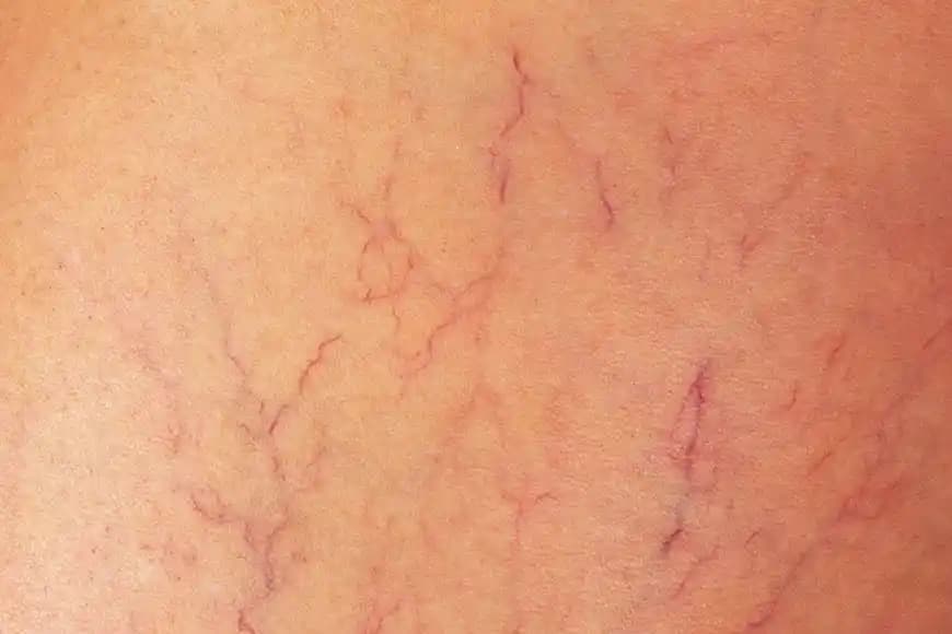 Vücutta Damar Çatlaması Nedenleri ve Kozmetik Çözüm Yöntemleri