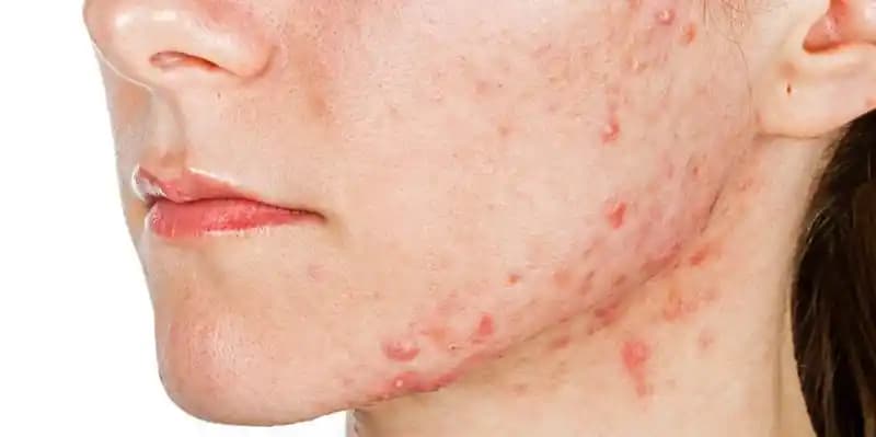 Vücutta İltihaplı Sivilcelerin Nedenleri ve Etkili Çözüm Yolları