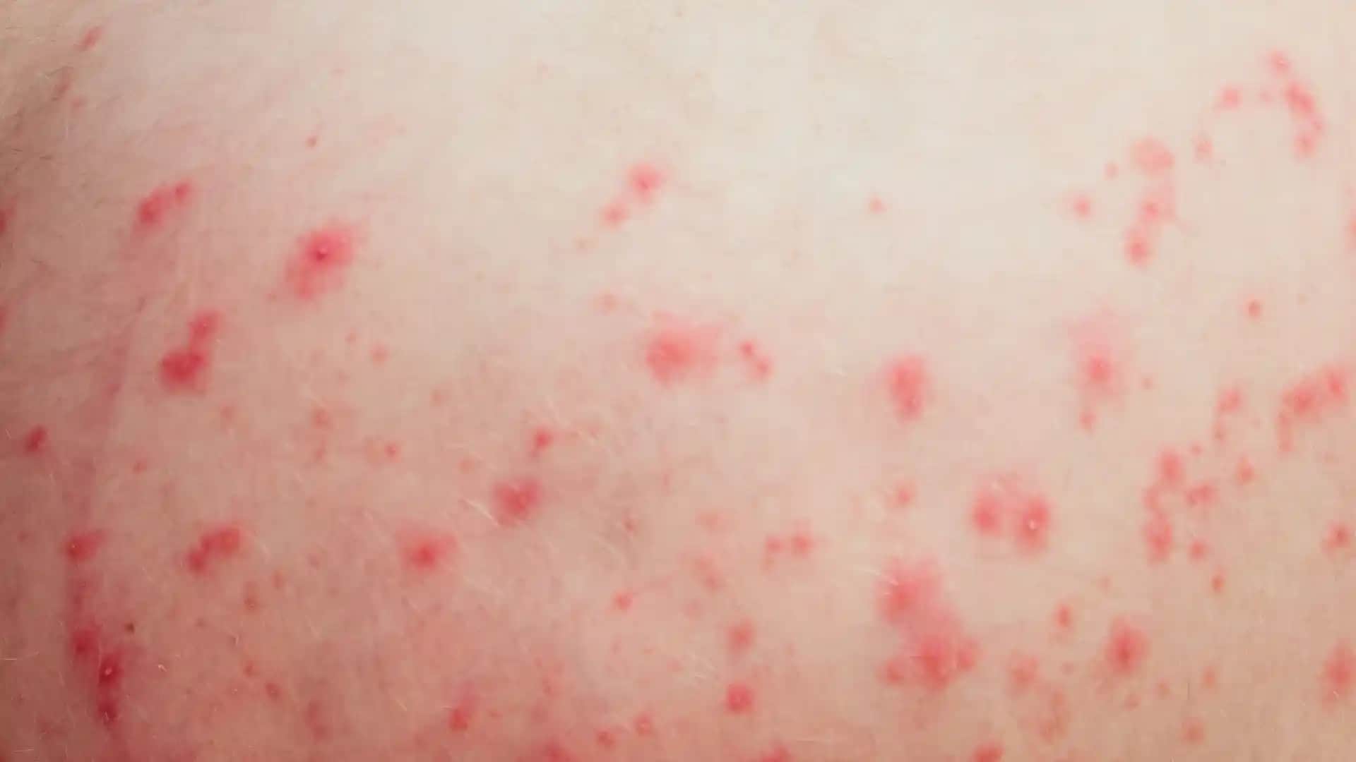 Vücutta Kırmızı Lekeler ve Kaşıntı: Nedenleri, Belirtileri ve Korunma Yöntemleri