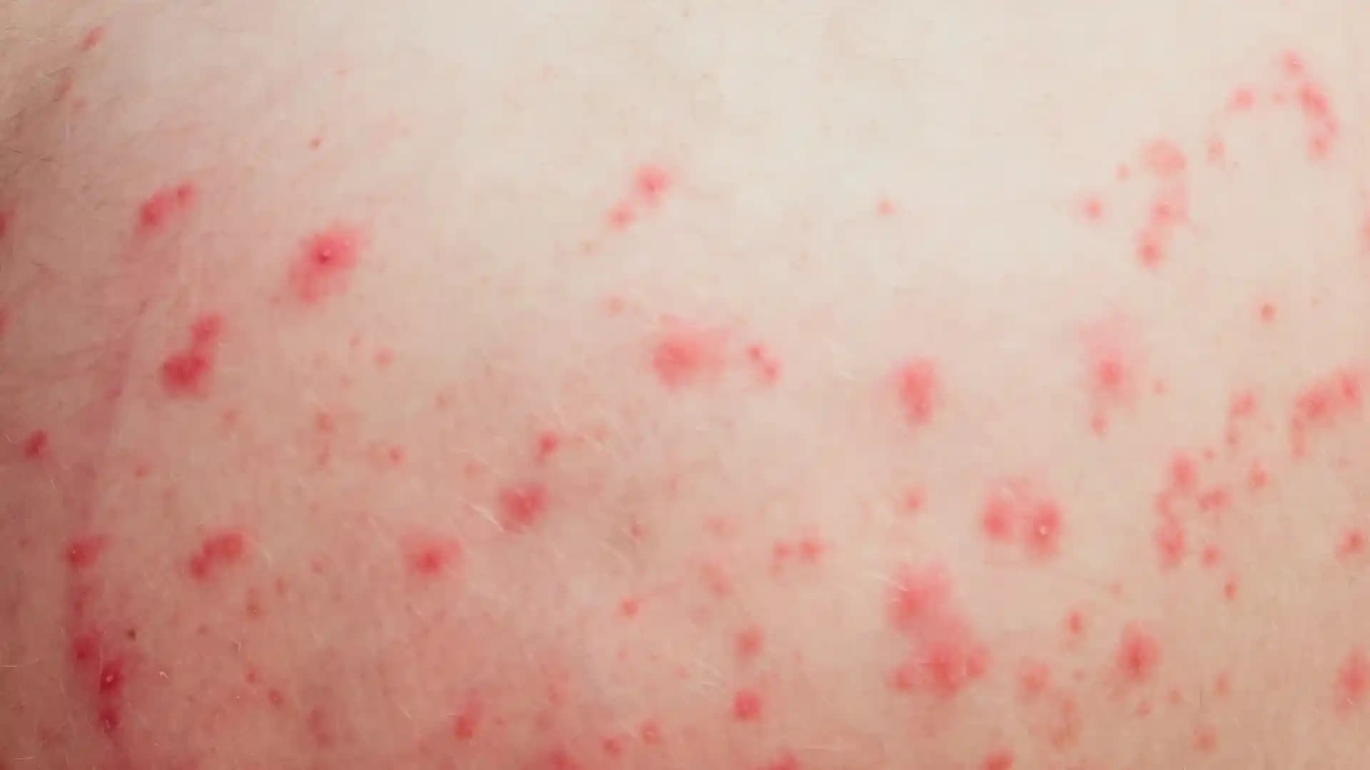 Vücutta Kırmızı Lekeler ve Kaşıntı: Nedenleri, Belirtileri ve Korunma Yöntemleri