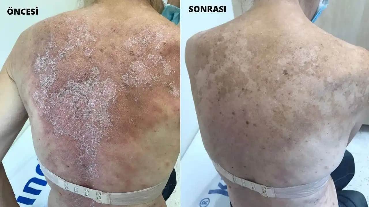 Vücutta Kızarıklık Nedenleri, Belirtileri ve Çözüm Yolları Hakkında Detaylı Bilgi