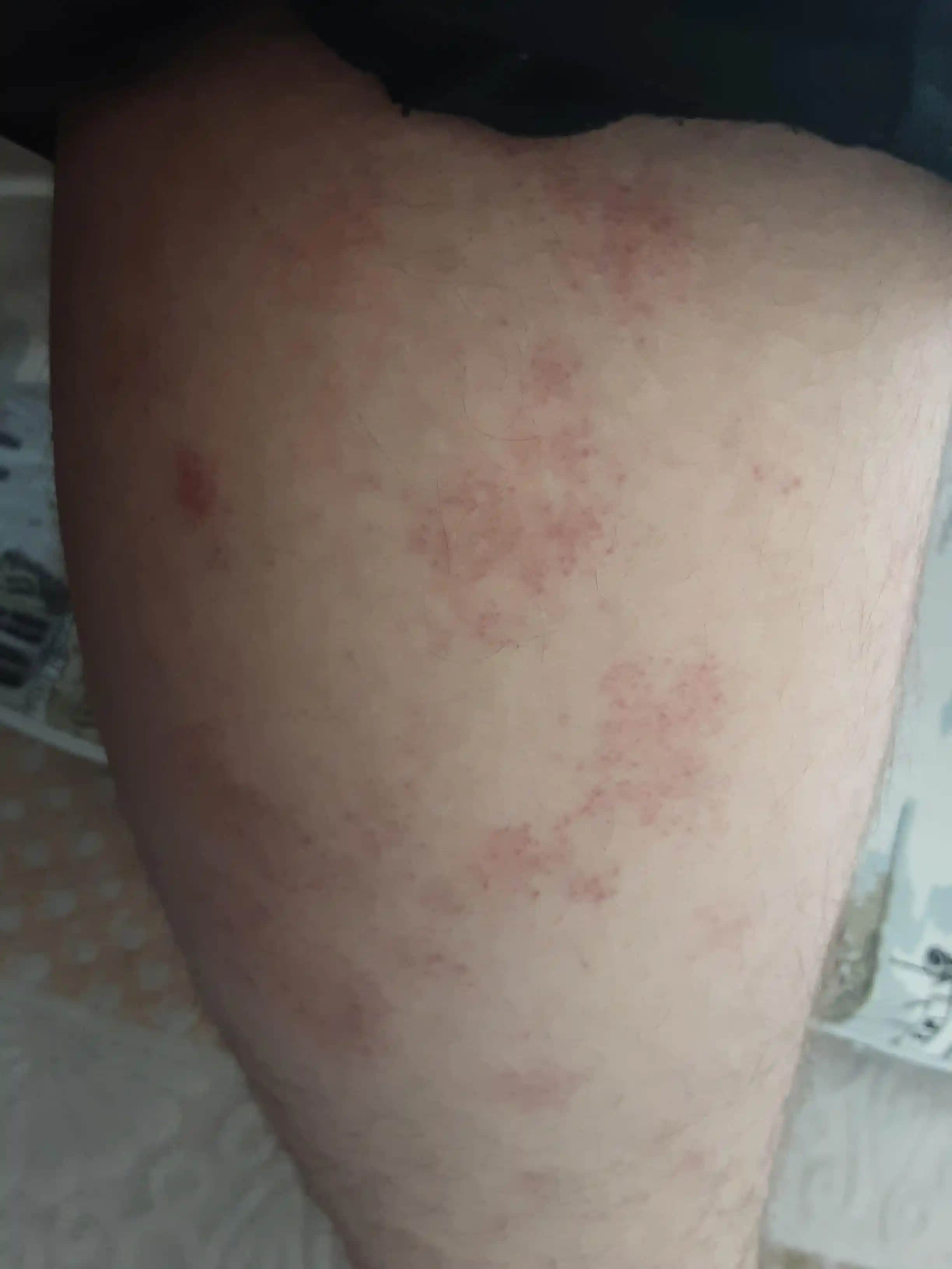 Vücutta Lekelenme Nedenleri ve Güzellik ile Sağlık Arasındaki İlişki