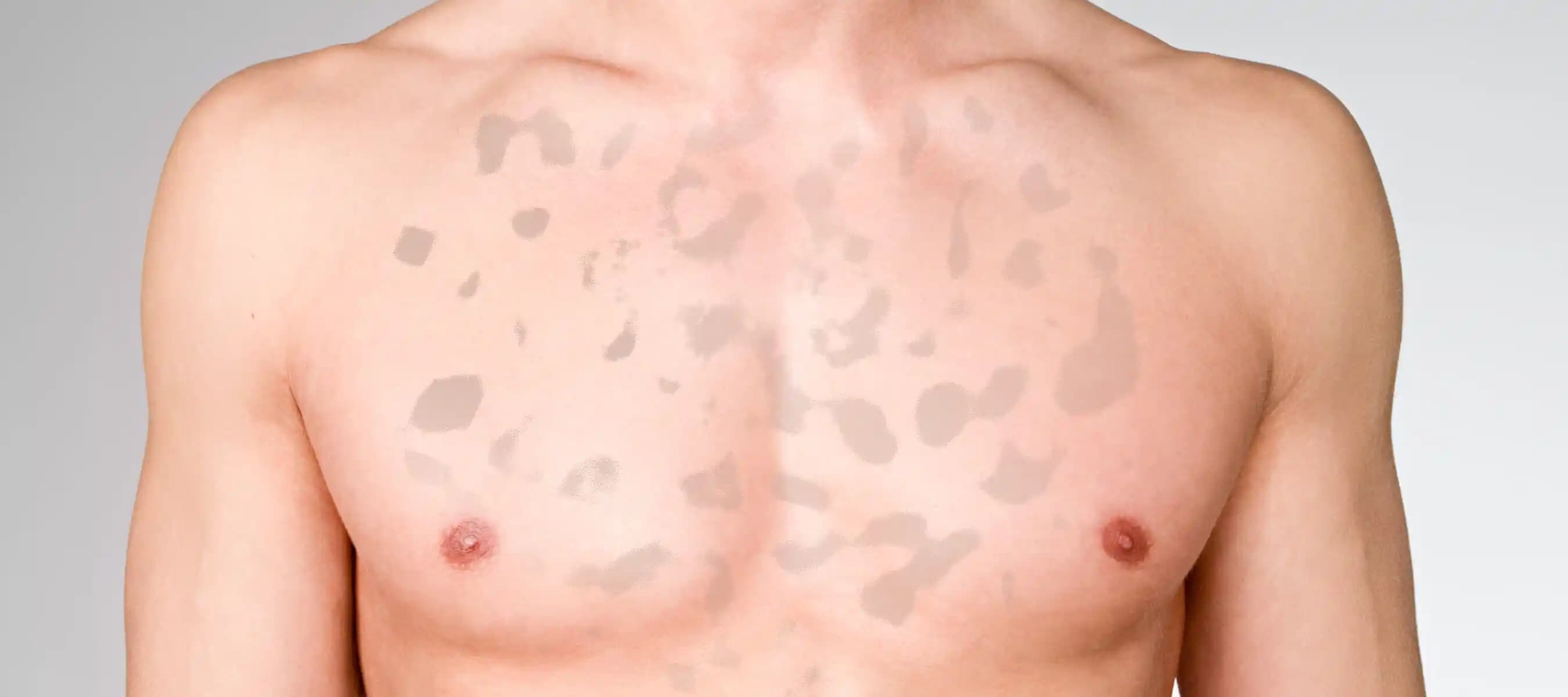 Vücutta Sarı Lekeler: Nedenleri, Belirtileri ve Etkili Çözüm Yöntemleri