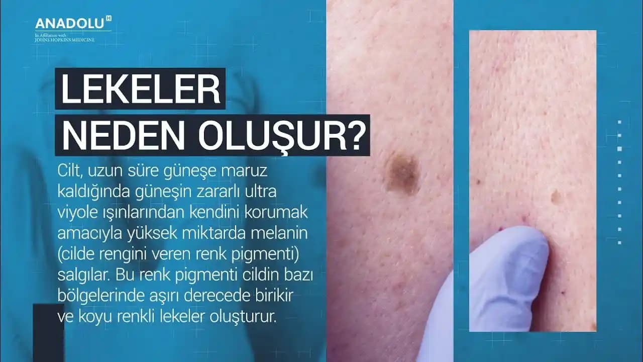 Vücutta Sarı Lekelerin Nedenleri ve Sağlıkla İlişkisi Hakkında Bilgiler