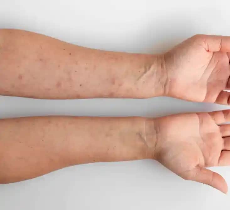 Vücutta Sedef Hastalığı: Belirtileri, Bakım İpuçları ve Tedavi Yöntemleri