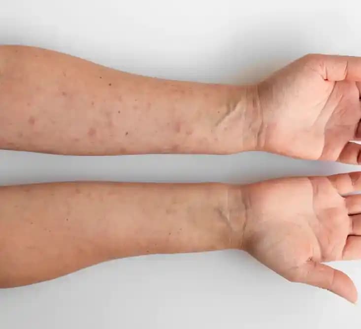 Vücutta Sedef Hastalığı: Belirtileri, Bakım İpuçları ve Tedavi Yöntemleri