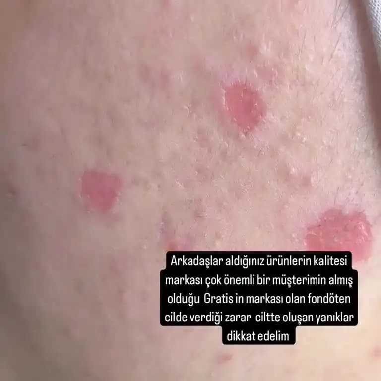 Vücutta Yanık Gibi Yaraların Nedenleri ve Etkili Tedavi Yöntemleri