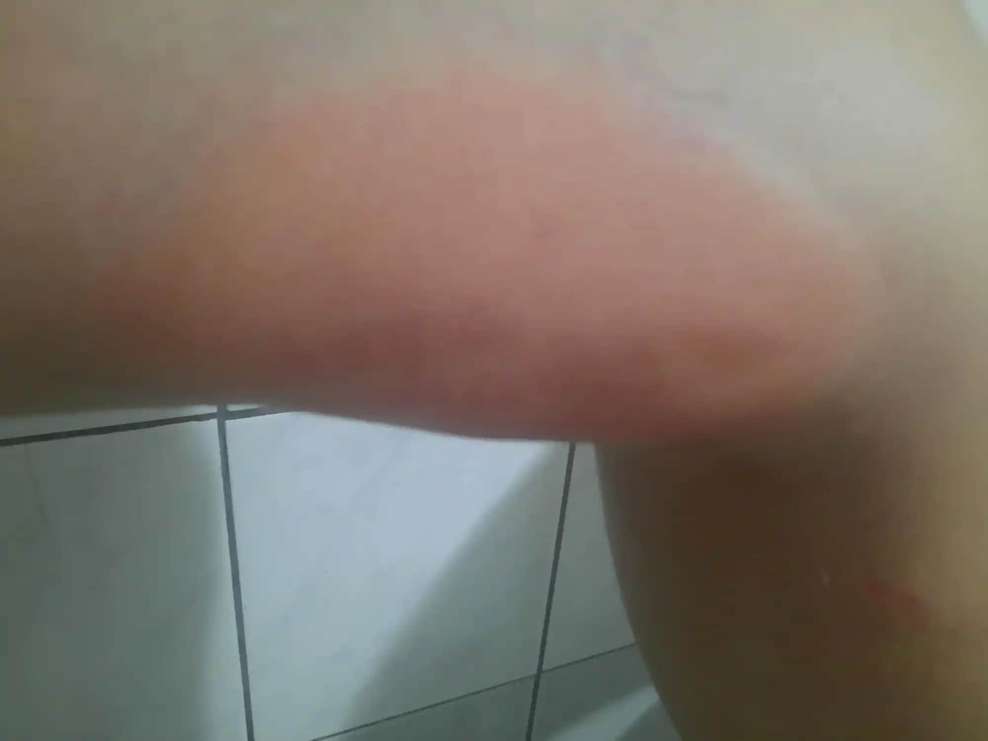 Vücutta Yaralar ve Kabarcıkların Nedenleri ile Doğru Bakım Yöntemleri