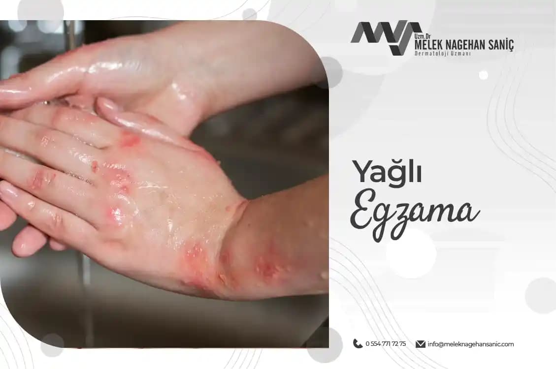 Yağlı Egzama Nedenleri, Belirtileri ve Kozmetik Ürünlerle İlişkisi Hakkında Detaylı Bilgi