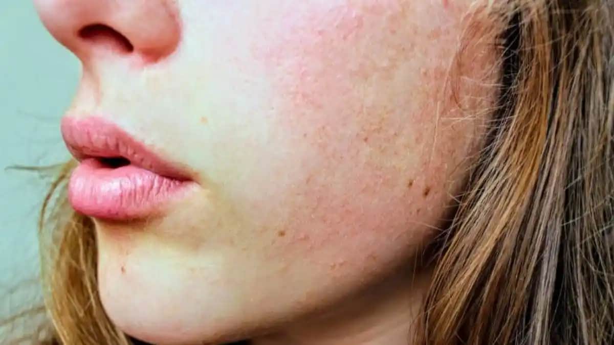 Yanaklarda Egzama: Belirtileri, Nedenleri ve Etkili Tedavi Yöntemleri
