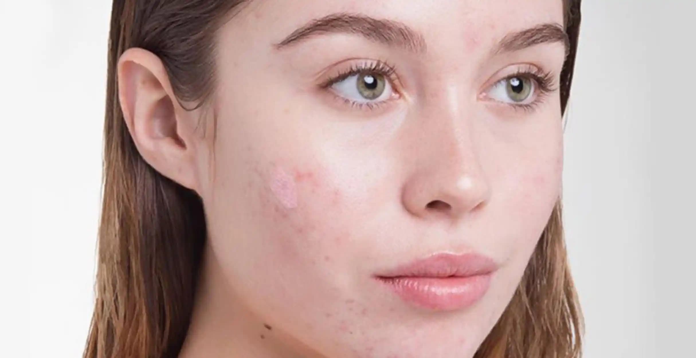 Yanakta Sivilce Nedenleri ve Etkili Çözüm Yöntemleri Hakkında Detaylı Bilgi