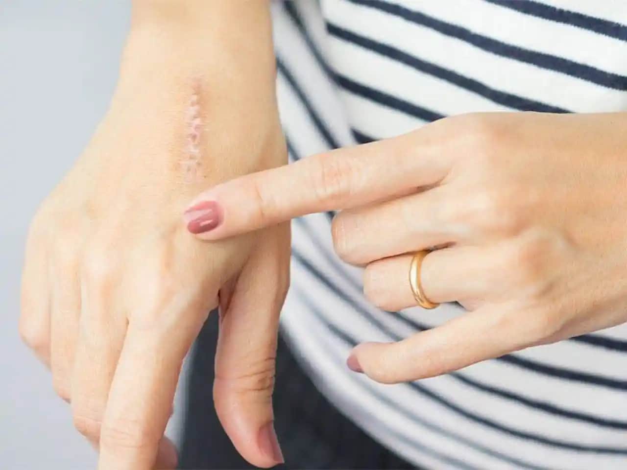 Yara İzleri Nedenleri ve Kozmetik Yaklaşımlar: Etkili Tedavi Seçenekleri ve Cilt Bakımı