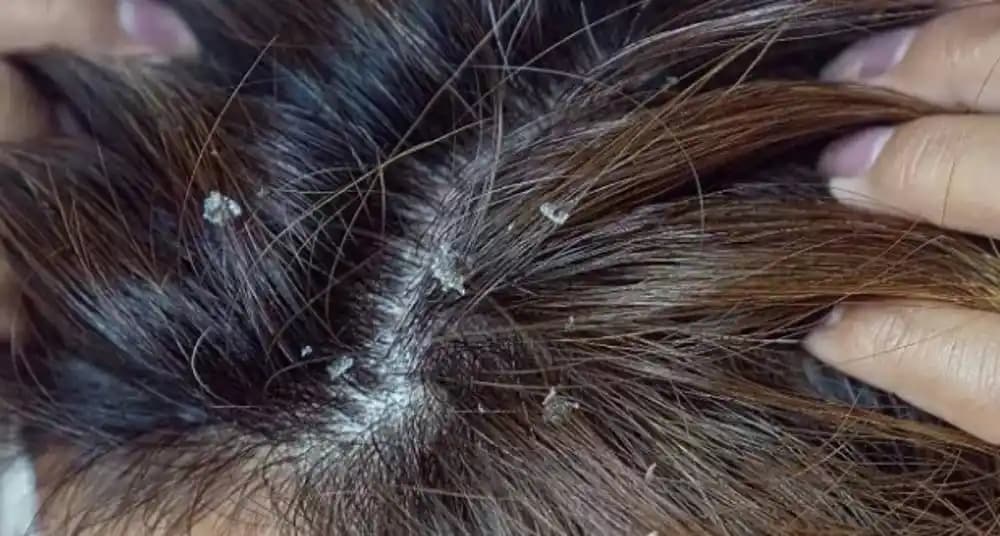 Yara Kabuklarının Geçmesi ve Cilt Sağlığını Hızlandıran Yöntemler