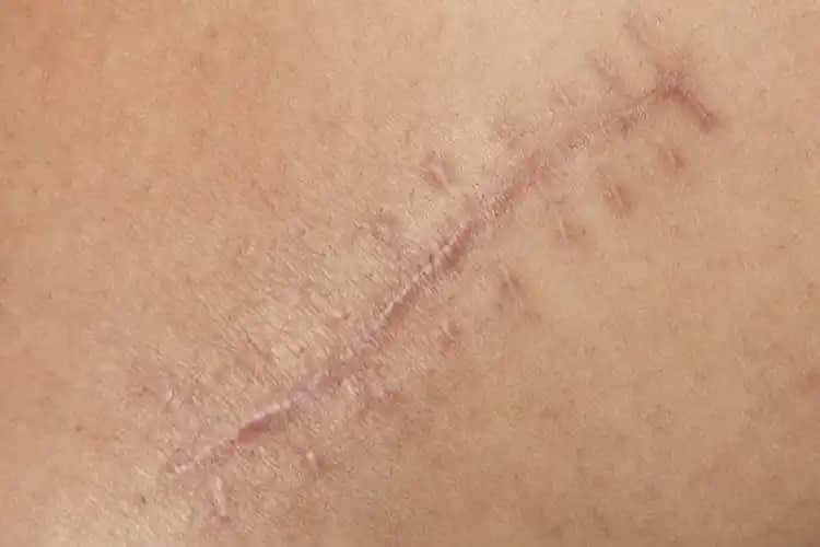 Yara Lekelerine Karşı Doğal ve Profesyonel Çözüm Yöntemleri ve Cilt Bakımı İpuçları