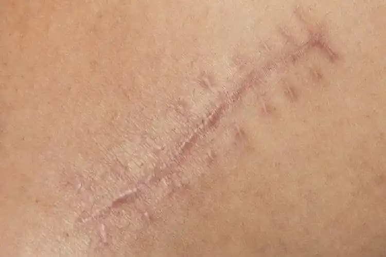 Yara Lekelerine Karşı Doğal ve Profesyonel Çözüm Yöntemleri ve Cilt Bakımı İpuçları