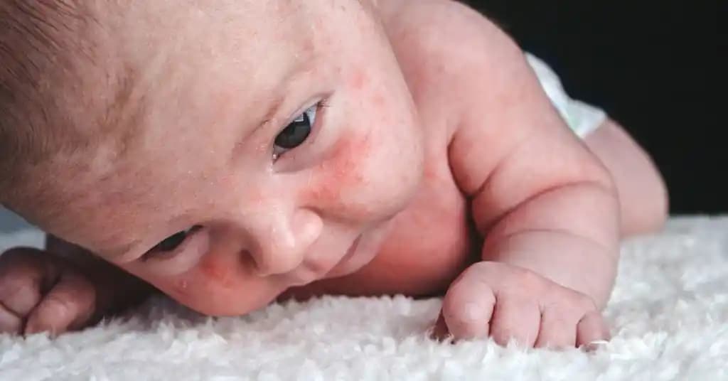 Yenidoğan Bebeklerde Yüzde Beyaz Noktalar Nedenleri Tanısı ve Bakım Yöntemleri