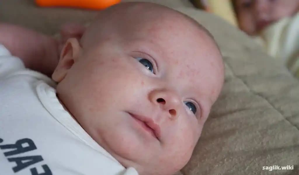 Yenidoğanlarda Yanaklarda Sivilce Nedenleri ve Doğru Bakım Yöntemleri