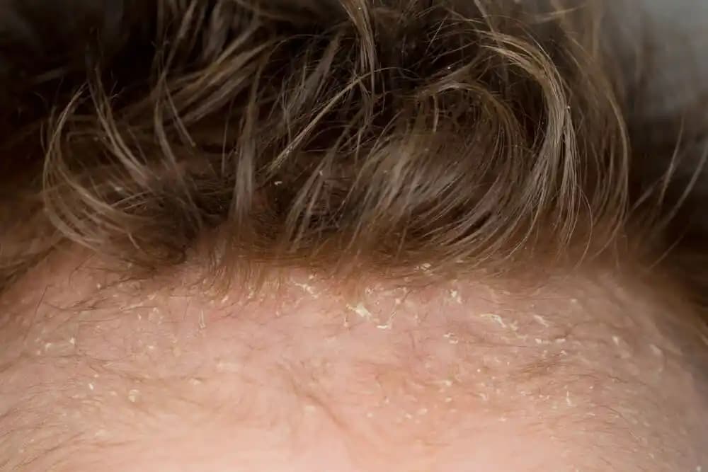 Yetişkinlerde Saç Dökülmesi ve Konak Problemleri İçin Bilmeniz Gerekenler